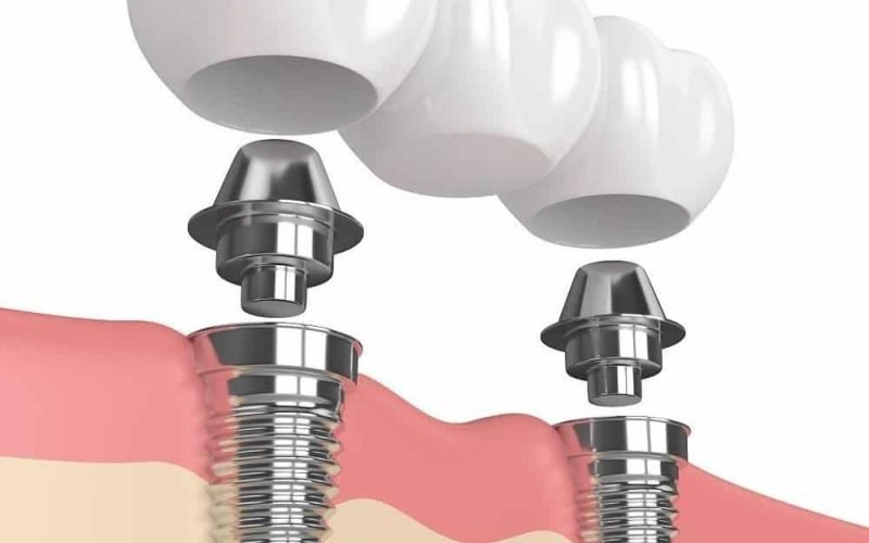 medical implants